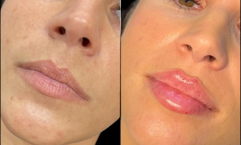 Juvederm