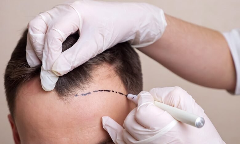 Hair Transplant in Dubai