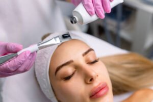 Laser Carbon Peel for Acne-Prone Skin