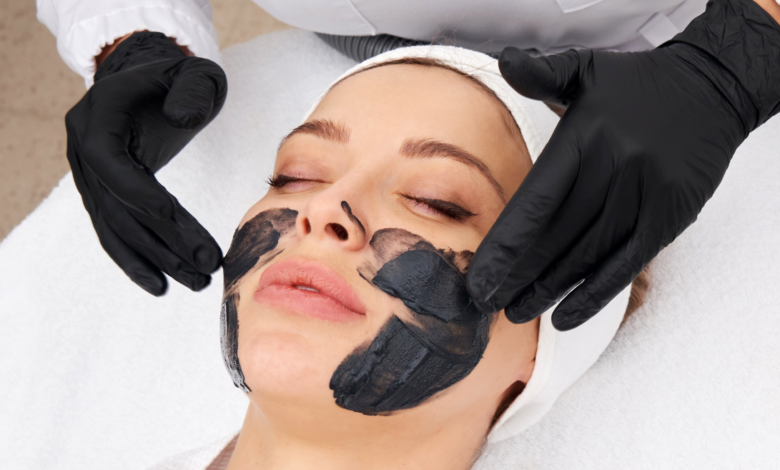 Laser Carbon Peel for Acne-Prone Skin