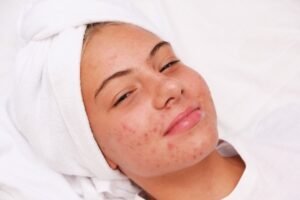 Minimally Invasive Acne Therapies 