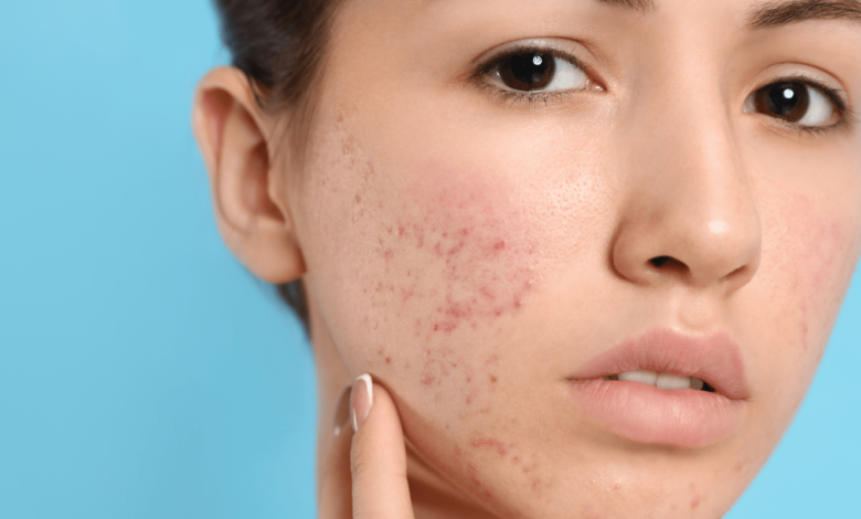 Minimally Invasive Acne Therapies