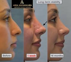 non-surgical rhinoplasty in Lahore