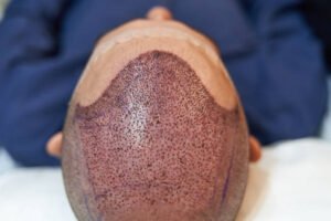 Expert Advice for Hybrid Hair Transplant Patients