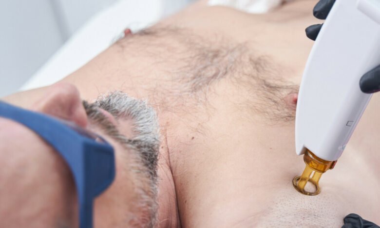 Permanent Hair Reduction for Men with Laser Technology