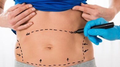 The incredible impact of Mini Tummy Tuck