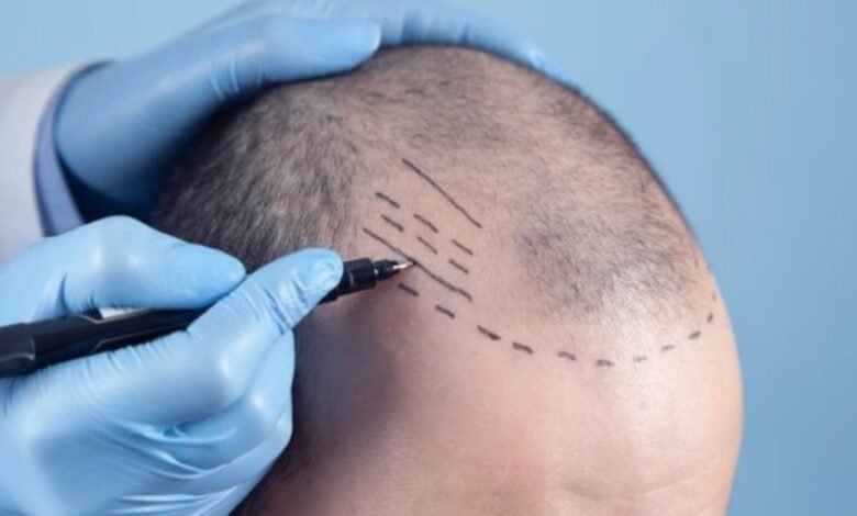 Hair Transplant in Dubai