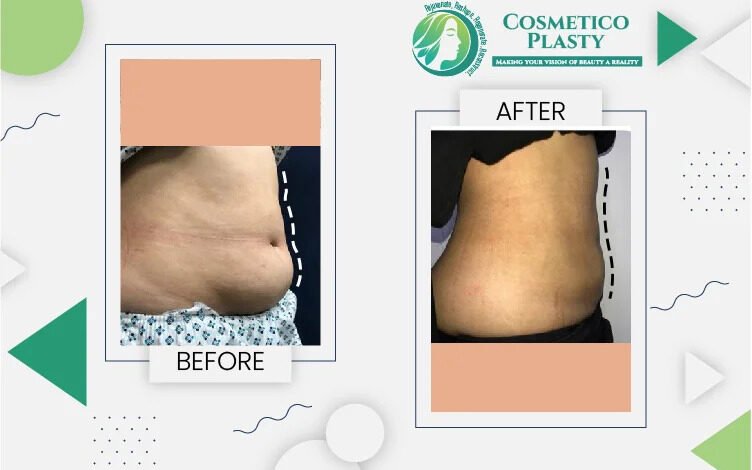 Liposuction Cost in Pakistan