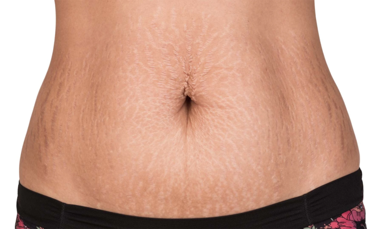 Affordable Stretch Mark Removal Treatments