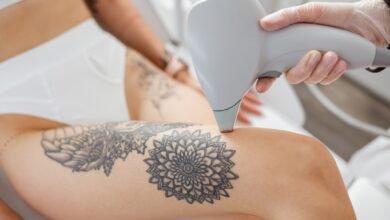 Can Laser Completely Remove a Tattoo