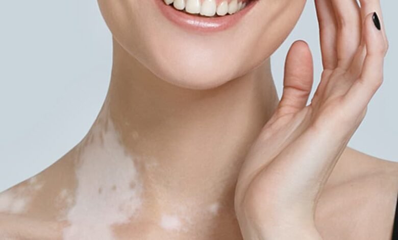 Comprehensive Guide to Vitiligo Treatment