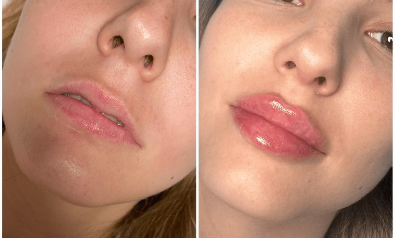 Juvederm