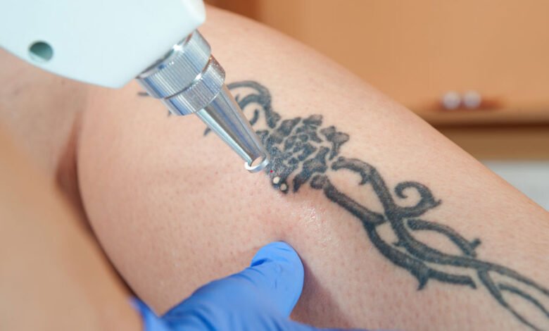 Fast and Efficient Tattoo Removal with Laser