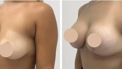 breast lift in dubai