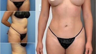 Body Contouring in dubai