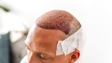 Non-Surgical Alternatives to Hair Transplant