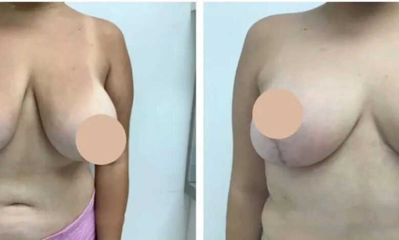 breast lift in dubai